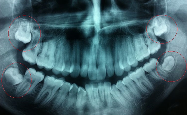 new-wisdom-tooth-x-ray