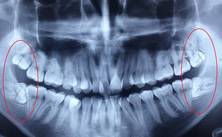 wisdom-tooth-improper-positioning
