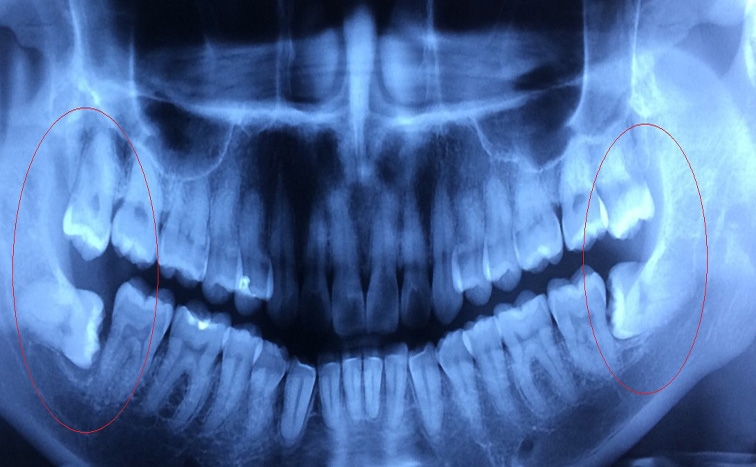 wisdom-tooth-x-ray